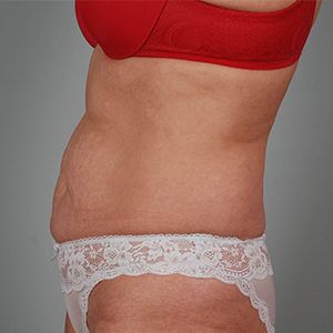 Abdominoplasty Before & After Patient #1209