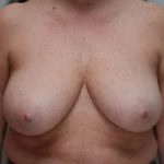 Breast Reduction Before & After Patient #1130