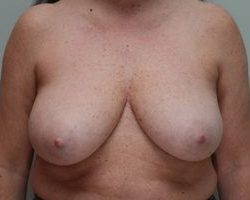 Breast Reduction Before & After Patient #1130