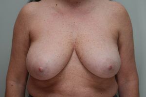 Breast Reduction Before & After Patient #1130