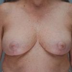 Breast Reduction Before & After Patient #1130