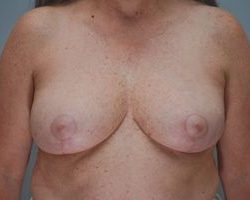 Breast Reduction Before & After Patient #1130
