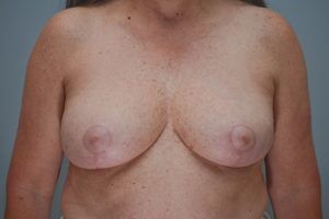 Breast Reduction Before & After Patient #1130