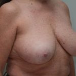 Breast Reduction Before & After Patient #1130