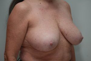 Breast Reduction Before & After Patient #1130