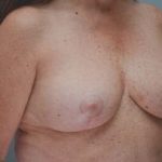 Breast Reduction Before & After Patient #1130