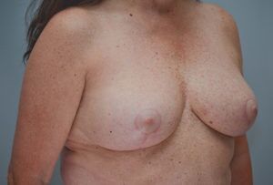 Breast Reduction Before & After Patient #1130