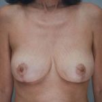 Breast Reduction Before & After Patient #1129