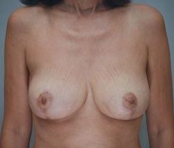 Breast Reduction Before & After Patient #1129