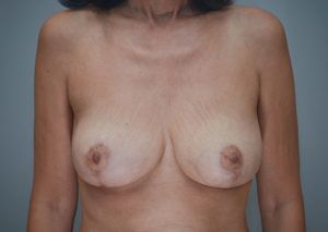 Breast Reduction Before & After Patient #1129
