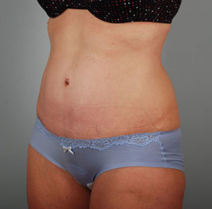 Abdominoplasty Before & After Patient #1330