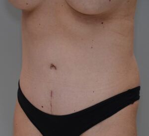 Abdominoplasty Before & After Patient #1493