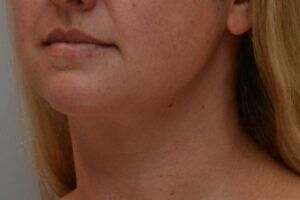 Neck Liposuction Before & After Patient #2008