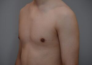 Gynecomastia Before & After Patient #1160