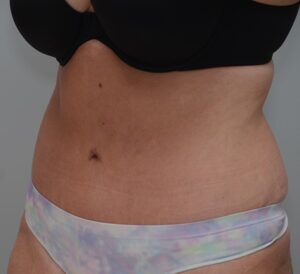 Abdominoplasty Before & After Patient #1496