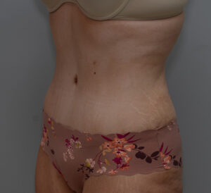 Abdominoplasty Before & After Patient #1495