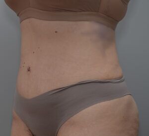 Abdominoplasty Before & After Patient #1494