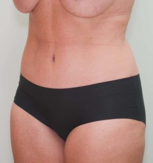 Abdominoplasty Before & After Patient #1326