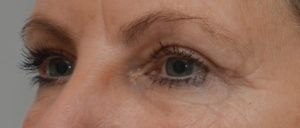 Blepharoplasty Before & After Patient #1704