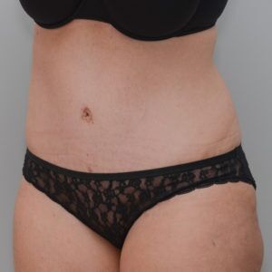 Abdominoplasty Before & After Patient #1387