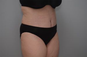 Abdominoplasty Before & After Patient #1210