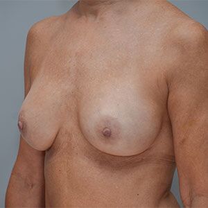 Breast Implant Exchange Before & After Patient #861