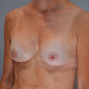 Breast Implant Exchange Before & After Patient #862