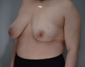 Breast Reduction Before & After Patient #1131