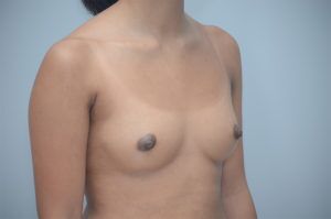 Breast Augmentation Before & After Patient #248