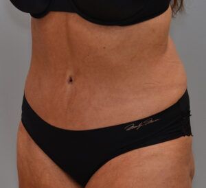 Abdominoplasty Before & After Patient #1443