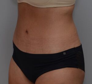 Abdominoplasty Before & After Patient #1442