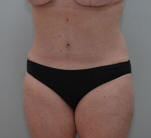 Abdominoplasty Before & After Patient #1444