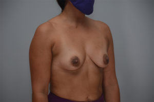 Breast Augmentation Before & After Patient #249
