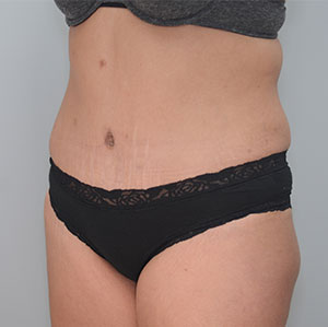 Abdominoplasty Before & After Patient #1273