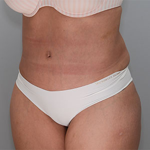 Abdominoplasty Before & After Patient #1329