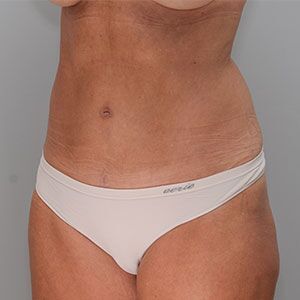 Abdominoplasty Before & After Patient #1328