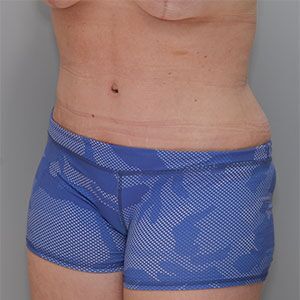 Abdominoplasty Before & After Patient #1272