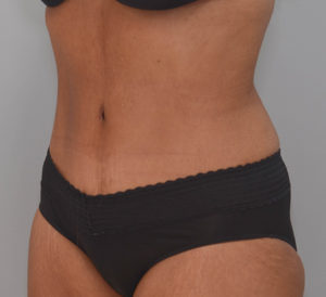 Abdominoplasty Before & After Patient #1386