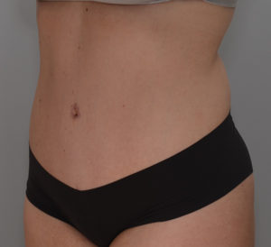 Abdominoplasty Before & After Patient #1385