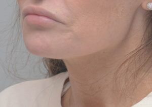 Neck Liposuction Before & After Patient #2003