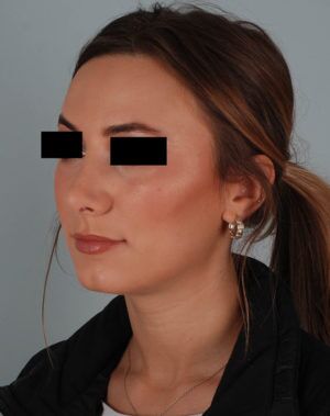 Rhinoplasty Before & After Patient #2113