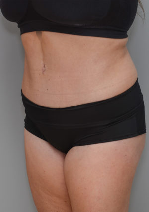 Abdominoplasty Before & After Patient #1211