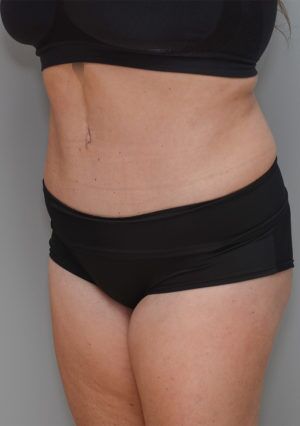 Liposuction Before & After Patient #1590