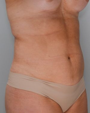 Liposuction Before & After Patient #1646