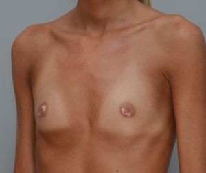 Breast Augmentation Before & After Patient #411