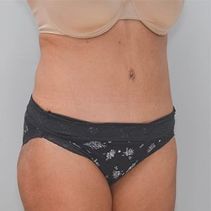 Abdominoplasty Before & After Patient #1207
