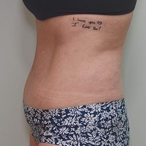 Abdominoplasty Before & After Patient #1209