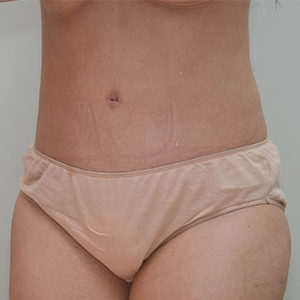 Abdominoplasty Before & After Patient #1208