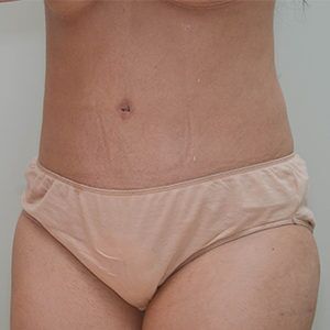 Abdominoplasty Before & After Patient #1587