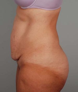 Abdominoplasty Before & After Patient #1330